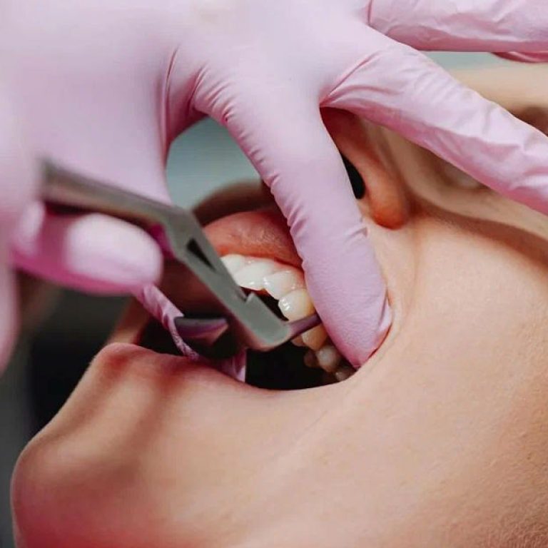 Extractions